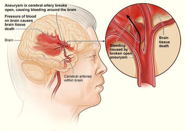 Stroke – HeMo Bioengineering Limited